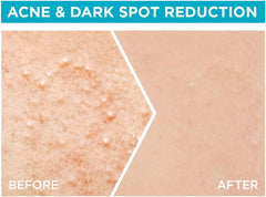 GARNIER FAST CLEAR SERUM 4% 15ML